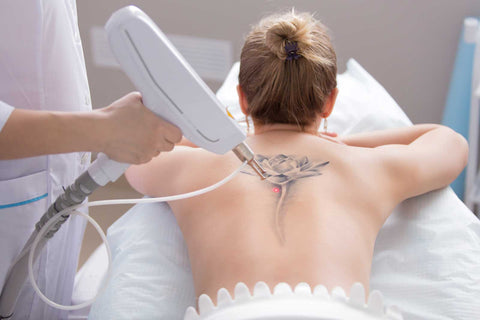 Come cancellare un tatuaggio