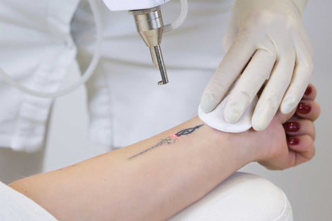 Quanto costa cancellare un tatuaggio?